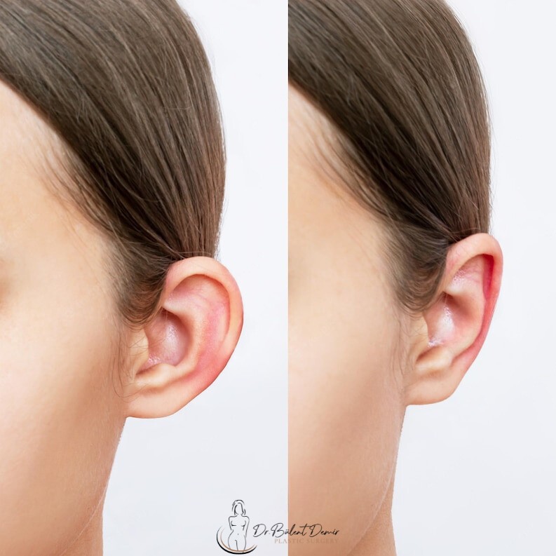 Otoplasty (Ear Surgery) in Antalya,Turkey